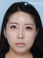 facial bone