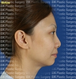 facial bone