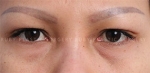 eye surgery
