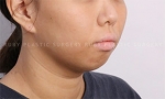 facial bone