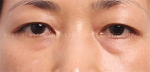 eye surgery