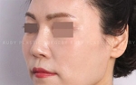 Rhinoplasty