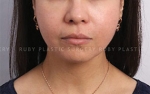 Ruby Plastic Surgery, Reviews, Images, Promotions — Korea cost, reviews & before-after | MISOODA