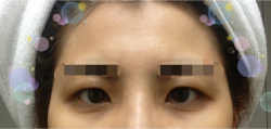 Hidden eyelids and Forehead fat grafting — Korea cost, reviews & before-after | MISOODA
