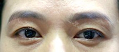 Eyebrow lift — Korea cost, reviews & before-after | MISOODA