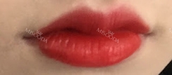 Lips Augmentation & Mouth Corner Lift Filler — Korea cost, reviews & before-after | MISOODA