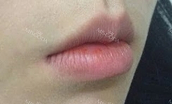 Lips Augmentation & Mouth Corner Lift Filler — Korea cost, reviews & before-after | MISOODA