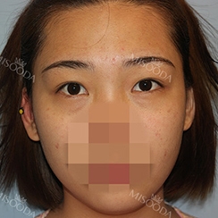 Incisional Double Eyelid, Lateral Canthoplasty, Eyelid Fat Removal — Korea cost, reviews & before-after | MISOODA