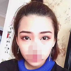 Incisional Double Eyelid, Lateral Canthoplasty, Eyelid Fat Removal — Korea cost, reviews & before-after | MISOODA