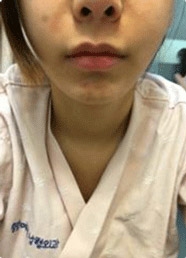 lips correction — Korea cost, reviews & before-after | MISOODA