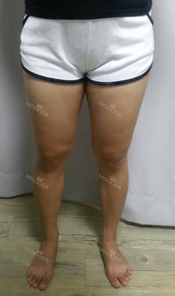 Thighs liposuction 2 — Korea cost, reviews & before-after | MISOODA