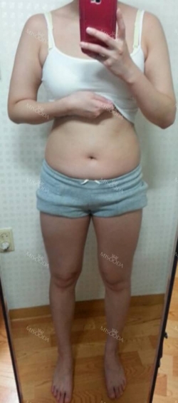 30 years old get your self confidence with a sexy body! — Korea cost, reviews & before-after | MISOODA