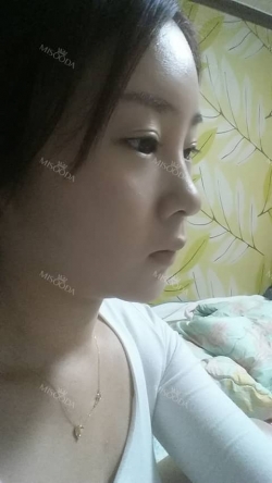 Face Liposuction — Korea cost, reviews & before-after | MISOODA