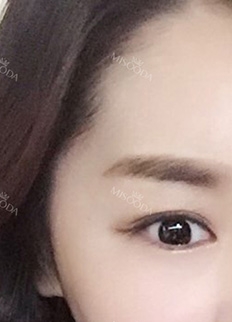 Twinkly Eyes! — Korea cost, reviews & before-after | MISOODA