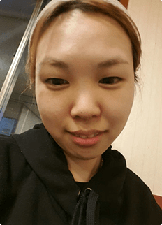 I became younger!! — Korea cost, reviews & before-after | MISOODA