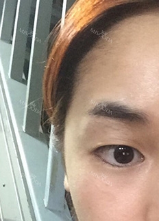 Twinkly Eyes! — Korea cost, reviews & before-after | MISOODA