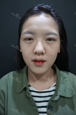 Chin Fillers! — Korea cost, reviews & before-after | MISOODA