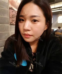 Rhinoplasty — Korea cost, reviews & before-after | MISOODA