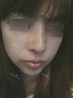 Nose Revision Surgery (3 times) — Korea cost, reviews & before-after | MISOODA