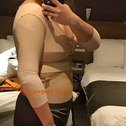 Liposcution surgery — Korea cost, reviews & before-after | MISOODA