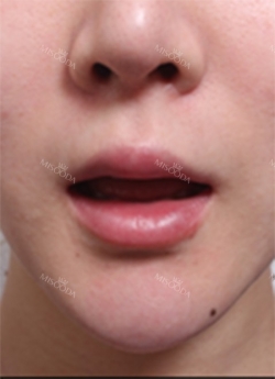 Lips and Fat Graft — Korea cost, reviews & before-after | MISOODA