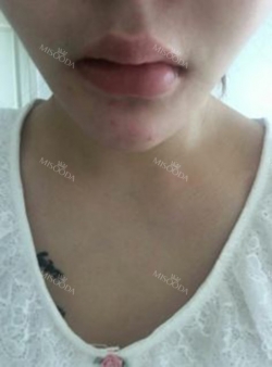 my beautiful lips — Korea cost, reviews & before-after | MISOODA
