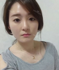Jaw chin — Korea cost, reviews & before-after | MISOODA