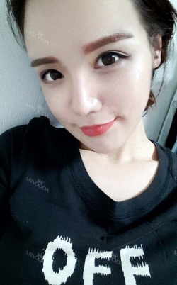 Eye, Nose, Micro Fat Grafting surgery real reviews! — Korea cost, reviews & before-after | MISOODA