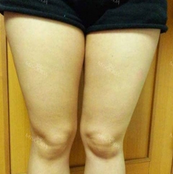 body, breast surgery — Korea cost, reviews & before-after | MISOODA