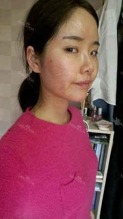 Eye, Nose, 3DCT-V-line Rectangular Jaw, Accessory Breast Removal, Micro Fat Grafting — Korea cost, reviews & before-after | MISOODA