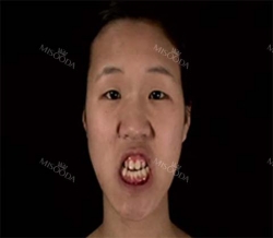 More natural, more Beautiful. The harmony of facial features! — Korea cost, reviews & before-after | MISOODA