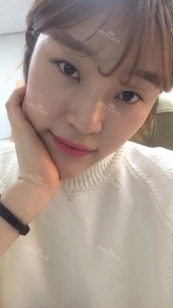 Ni (ptosis) + epi + lat — Korea cost, reviews & before-after | MISOODA