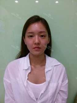 Reviews, Cheekbone, Square jaw at View plastic surgery clinic — Korea cost, reviews & before-after | MISOODA