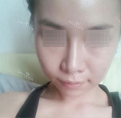 Convex Mouth Correction + V-line Reshaping — Korea cost, reviews & before-after | MISOODA