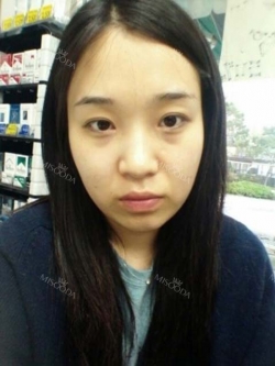 ar zy t (adv heading), fg (forehead), rhino (lo), pa (sil), aky ni (ptosis re), lat — Korea cost, reviews & before-after | MISOODA