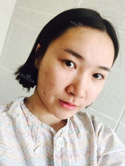 Ar + Zy + T + Pa (sil) + Rhino + weir + Ni (re) ptosis + Lat — Korea cost, reviews & before-after | MISOODA