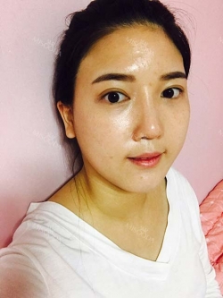 Ar + Zy + T + LP (jaw line) + thread lifting + (tack) Rhino (re) — Korea cost, reviews & before-after | MISOODA