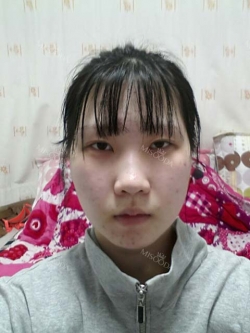 Ar + Zy (PPC) + T / adv + NI / ptosis + Rhino / lo #Free — Korea cost, reviews & before-after | MISOODA