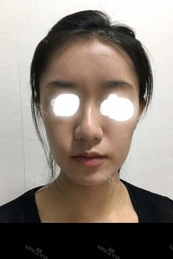 I did Thigh Liposuction and full face fat grafting, and nose filler injection. — Korea cost, reviews & before-after | MISOODA