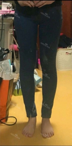 Thigh Liposuction + Calf Reduction — Korea cost, reviews & before-after | MISOODA