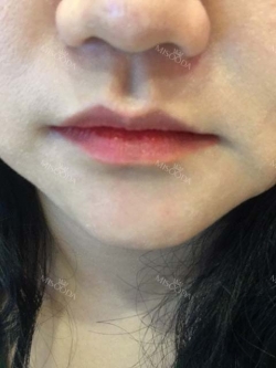 Lip Filler — Korea cost, reviews & before-after | MISOODA