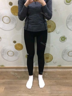 Thigh Liposuction — Korea cost, reviews & before-after | MISOODA