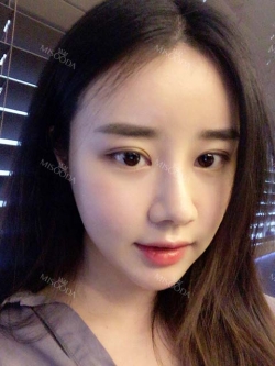 After 5 months of nose surgery — Korea cost, reviews & before-after | MISOODA