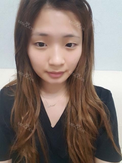 After 6 months of Eye, Nose, Fat grafting Surgery — Korea cost, reviews & before-after | MISOODA
