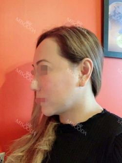 Revision Rhinoplasty, Fat graft, Skin Injection — Korea cost, reviews & before-after | MISOODA
