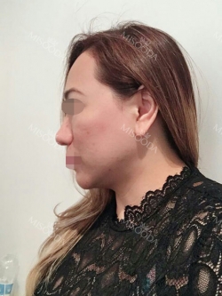 Revision Rhinoplasty, Fat graft, Skin Injection — Korea cost, reviews & before-after | MISOODA