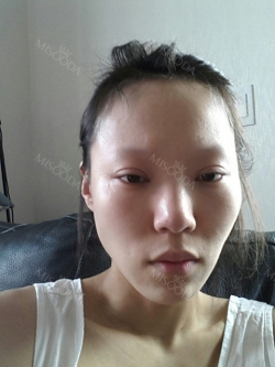 Rhinoplasty & Double Eyelid Revision Surgery — Korea cost, reviews & before-after | MISOODA