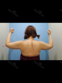 Arm & Bra Line Liposuction — Korea cost, reviews & before-after | MISOODA