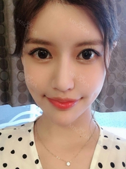 I got surgery at eyes, nose as reoperation and bon contour surgery, fat graft with Jewelry surgery center. — Korea cost, reviews & before-after | MISOODA
