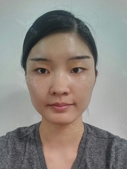 Boring to boomz — Korea cost, reviews & before-after | MISOODA